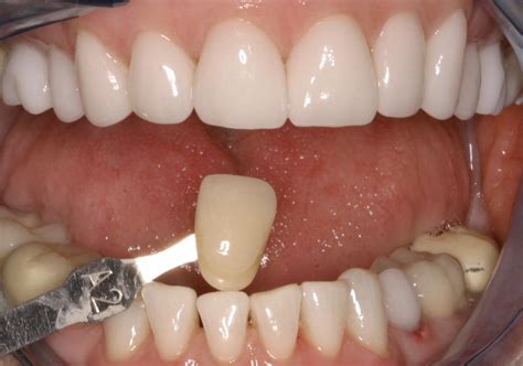 Kein frei käuflicher zahnaufheller kann den zahnarzt ersetzen. FRENKENKLINIK: Beitrag 117 aus der FRENKENKLINIK: Gelbe ...