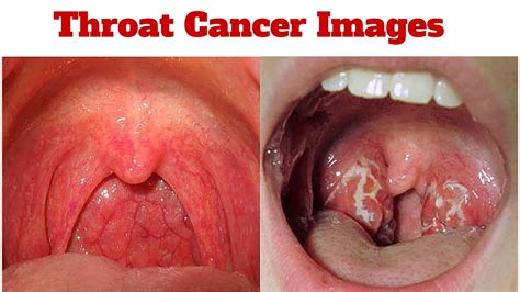 Symptoms of oral and throat cancers (from any cause) include a swelling or lump in the mouth, a painless lump on the outside of the neck, an enlarged tonsil, and a sensation of having a foreign. Throat cancer