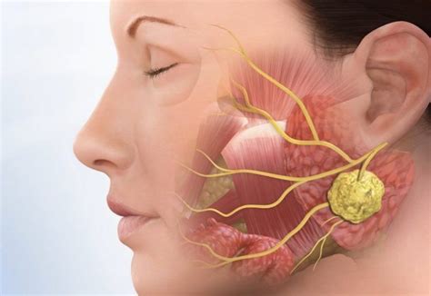 Parótida submaxilar o submandibular sublingual 2. Tumores benignos en las glándulas salivales: síntomas y ...