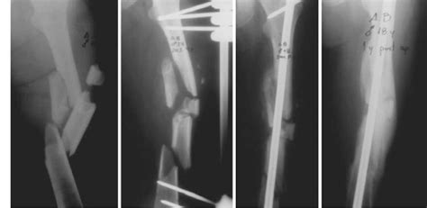 Segmental open (grade II) femoral fracture in a poli ...