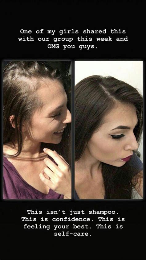 Female pattern hair loss (female androgenetic alopecia) is a common, but puzzling, condition in women. before/after in 2020 | Diy hair loss treatment, Biotin for ...