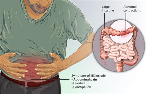 Difference Between Irritable Bowel Syndrome IBS and Ulcerative Colitis | Difference Between