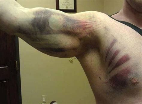 All intercostal muscles originate on the lower border of a rib and attach to the upper border of the rib below. Guy gets hit by a truck. Bruises leave perfect imprint of ...