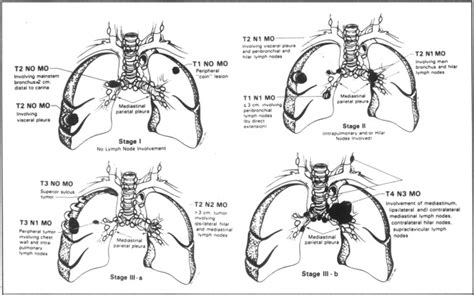 What are lung cancer symptoms and signs? Staging Systems of Lung Cancer - Mayo Clinic Proceedings