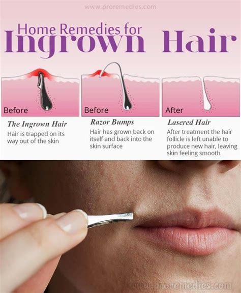 Ideally, if you do it in the evening when you are. How to Properly Remove Ingrown Hair ? in 2020 | Ingrown ...