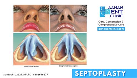 Exposure to air pollution and cigarette. Deviated Nasal Septum & Septoplasty - What you need to ...