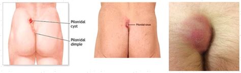 New scientific trials prove that the recurrence rate is being reduced by half. Pilonidal-Sinus - Chilliwack Electrolysis Hair Removal ...