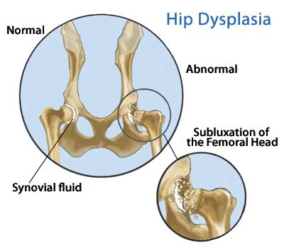 This causes the hip joint to gradually lose its range of motion and potentially require hip joint replacement. karime