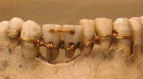 Apakah pasang gigi palsu bisa pakai bpjs? Temuan Mengejutkan Gigi Palsu Paling Tua di Eropa - Global ...