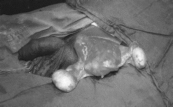 The müllerian ducts are paired embryologic structures that undergo formation, fusion and interruption of the normal development of the ducts can result in müllerian duct anomalies (mdas). Persistent müllerian duct syndrome with transverse ...