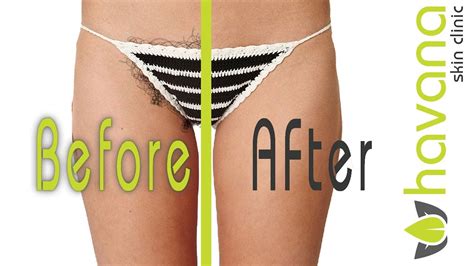 Bikini line hair removal is an important part of personal grooming. Bikini laser removal