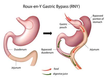 Gastric bypass is usually covered by most insurances including medicare and medicaid. Roux-en-Y Gastric Bypass (RNY) surgery, eps8 - Obesity Coverage