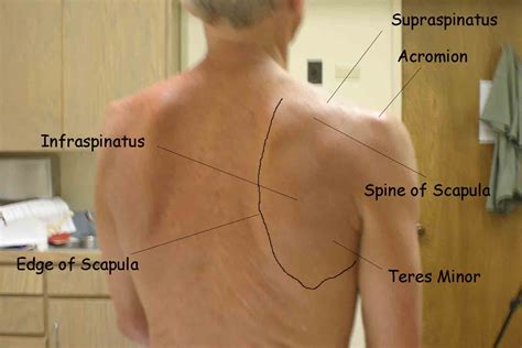 Shoulder tendonitis is inflammation of your rotator cuff or bicep tendons, often caused by overuse of the arms such as in baseball, weight lifting, and racket sports. Shoulder Tendon Anatomy Posterior : Rotator Cuff Rehab ...