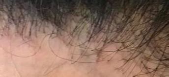 The patient has an absence of vellus hairs from the ...