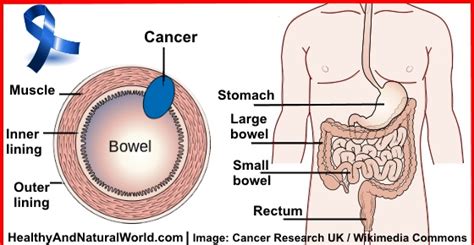 We have about 145,000 cases of. 10 Warning Signs of Bowel (Colorectal) Cancer You Shouldn ...