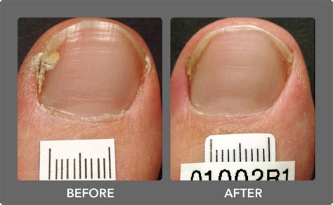 You can also dilute tea tree oil by up to 50 percent in a carrier oil applied twice daily to the affected area to clear up the symptoms of nail fungus. Toenail Fungus Laser Treatment | Boca Raton Podiatrist