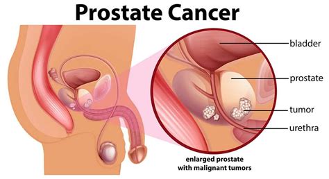Prostate cancer may spread ( metastasize) and form tumors in nearby organs or bones. The 10 Most Relevant Signs & Symptoms of Prostate Cancer!