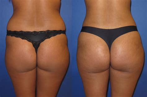 Your own body fat is used to augment the buttocks in the most natural of ways. Brazilian Butt Lift