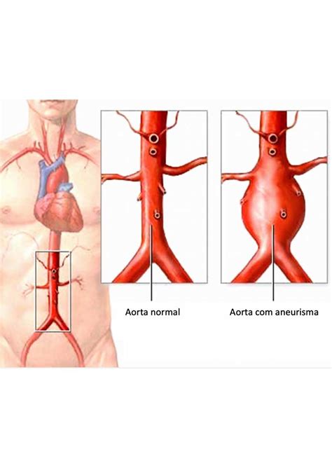 Dependendo da área do corpo que é afetado, o aneurisma pode ser classificado em 4 tipos diferentes. Aneurisma da Aorta Abdominal. O que preciso saber?