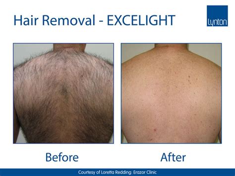 Although you may need to have several treatment sessions, the procedure is typically quick, with only minor discomfort experienced during and after the treatment. Laser Hair Removal | IPL - Marsh Medical Skin Clinic ...