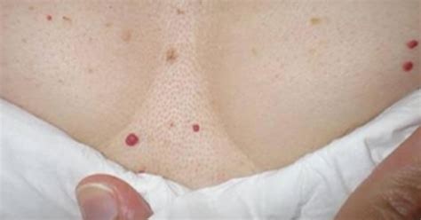 Although they can appear anywhere on the body, they commonly appear on the face, lip, torso, and scalp. Cherry Angiomas: The Red Spots in Your Body and Why They ...