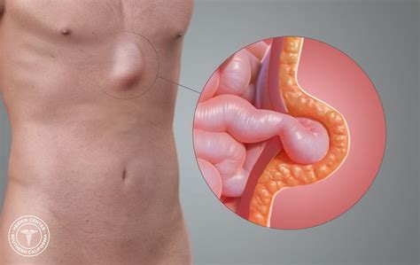 Hernioplasty is a type of hernia repair surgery where a mesh patch is sewn over the weakened region of tissue. Suffering from Epigastric Hernia? Seeking for epigastric ...