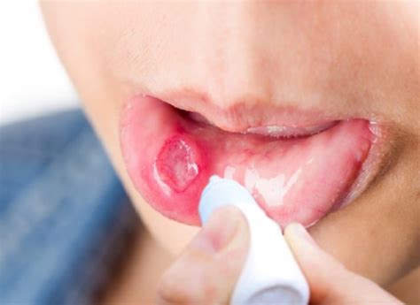 Berikut ini adalah fungsi vitamin berdasarkan jenisnya : Berikut Adalah Akibat Dari Kekurangan Vitamin A Kecuali ...