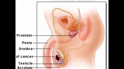With timely diagnosis, testicular cancer is most likely treatable and most often curable. Testicular Cancer Self Exam - YouTube