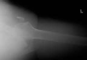 Coracoid Fracture
