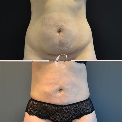 Maybe you would like to learn more about one of these? Laser Liposuction Sydney | What Is Laser Liposuction?