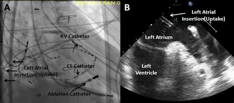 The coronary sinus is the largest cardiac venous structure. Patient with a TandemHeart device in place. A, Is a right ...
