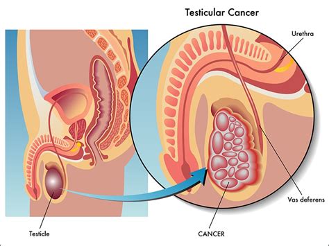 But some men might have some of the following: Chemo Linked to Increased CVD Risk in Testicular Cancer