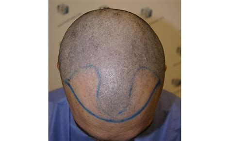 Nach einer haartransplantation ist also erst mal geduld gefragt. BEST Hair Transplant Klinik mit natürlichen Ergebnissen ...