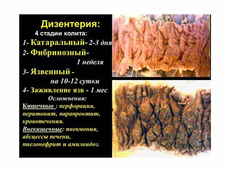 Диета при вирусно кишечных инфекциях