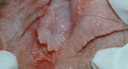 There are more than 100 different types of hpv. Spring Dermatology