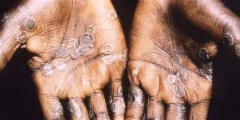 Diagnosis come after an examination by a specialist. Case of monkeypox confirmed in England after patient had ...