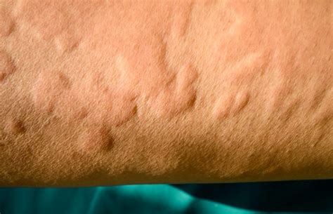 There are several different types of skin allergies such as allergic contact dermatitis, urticaria (hives) and photoallergy. Different skin allergies - causes and treatments | Health24