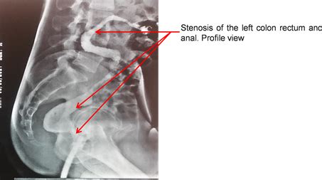 If the digital rectal examination is inconclusive, then anoscopy can be used to furthe. Rectal-Colitis Caustic Stenosing by Enema to Traditional ...