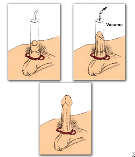 Gambar kartun memakai maser ~ gambar orang yang memakai topeng perubatan dan pelindung muka pandemik pelindung muka perlindungan png dan vektor untuk muat turun percuma. Melihat Yang Akan Di Pump Cukong - SURYA MEDILAB - MENJUAL ...