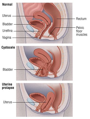 This is a container as well as (bad) armor. Uterine prolapse. Causes, symptoms, treatment Uterine prolapse