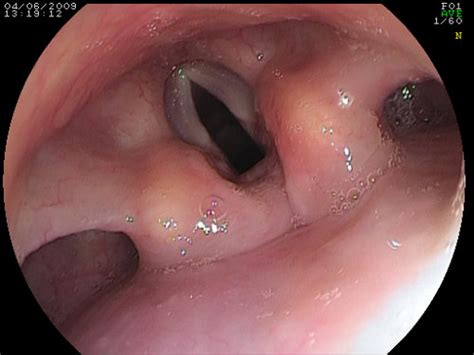 Un cattivo alito, naturalmente, può essere anche correlato alla dieta e, senza scomodare il (alcol, arsenico, selenio) diabete, insufficienza epatica e renale di cui è tipico il cosiddetto alito uremico. Alito pesante? Lo stomaco non c'entra! | MEDICITALIA.it