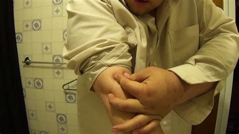 We did not find results for: Abscess Explodes - for educational purposes only - YouTube