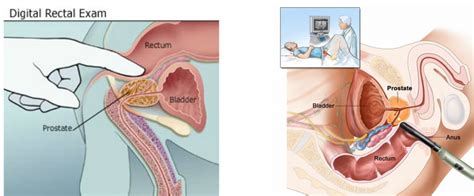 A complete physical examination includes a digital rectal examination. Prostate Cancer - Cancers of the Male Reproductive System