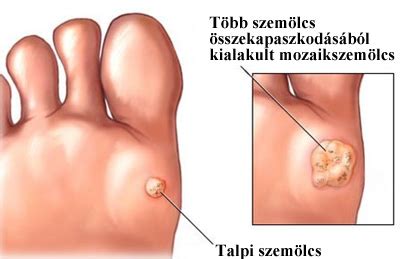 Hpv okozta szemölcs, futószemölcs, uszodaszemölcs. Vírusos szemölcs, vírusszemölcs, futószemölcs lézeres ...