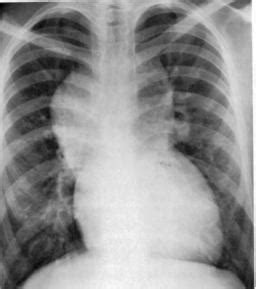 Some infants with unobstructed supracardiac or cardiac total anomalous pulmonary venous return may be asymptomatic. Anomalies