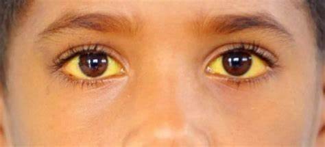 Диета при аутоиммунный Аутоиммунный гепатит (воспаление печени) – симптомы, диагностика Аутоиммунный гепатит (воспаление печени) – симптомы, диагностика Диета при аутоиммунный