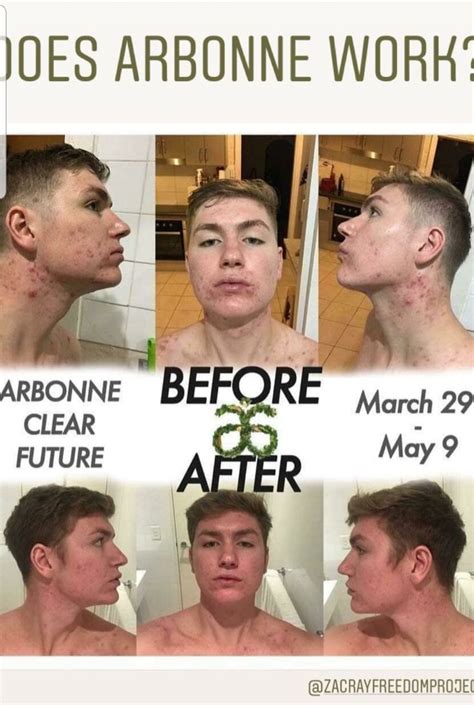 When autocomplete results are available use up and down arrows to review and enter to select. Results of Arbonne's incredible Acne Line! For anyone who ...