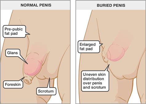 Kids can use crayons, markers, and colored pencils to draw. Buried penis reconstruction