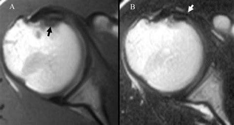 Lister's tubercle or the dorsal tubercle of the radius is a bony protuberance on the dorsal surface of the distal radius. A, T1-weighted image showing a low-intensity area at the ...
