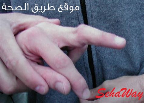 This is a sign that the finger is broken. ماذا تفعل عند إصابة مفاصل أصابعك بالخلع ؟؟ | طريق الصحة